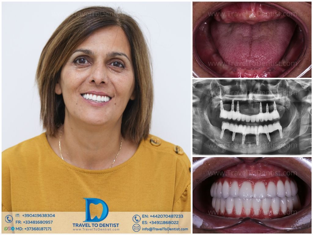Caso clínico 5 - Dental Sur